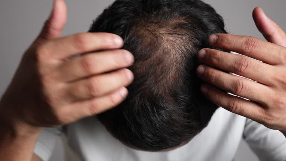 PRP for Hair Loss Treatment
