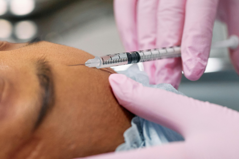 Botox for Migraines by Dr Camille